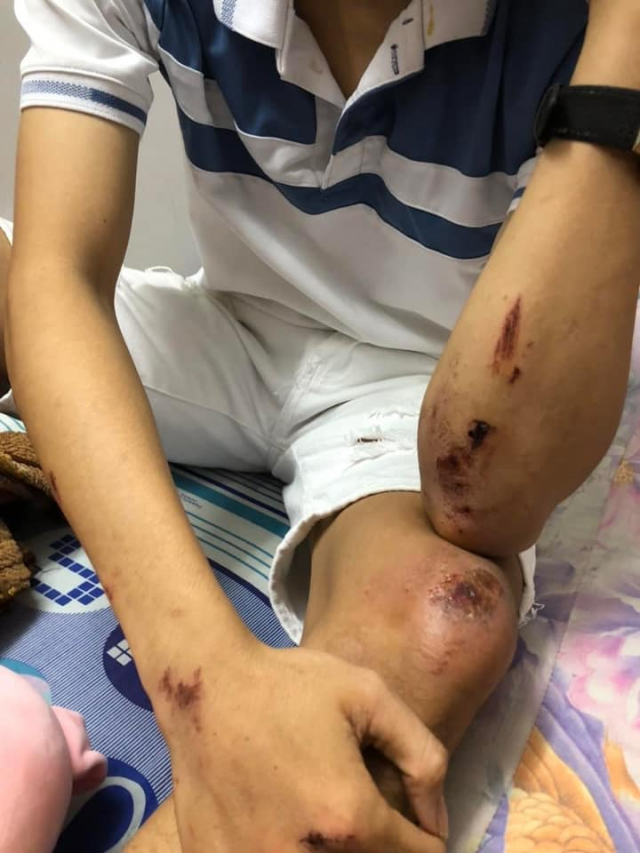 Khong the tat den xe nam thanh nien roi vao ban nhau va bi ca hoi tac dong vat ly - 4